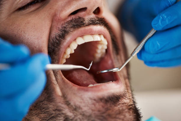 Best Emergency Treatment for Dental Infections or Abscesses in Pleasant Hill, TX